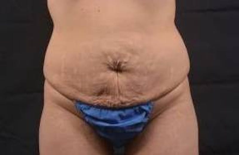 Abdominoplasty Before & After Gallery - Patient 117112 - Image 1