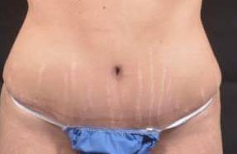 Abdominoplasty Before & After Gallery - Patient 117112 - Image 2