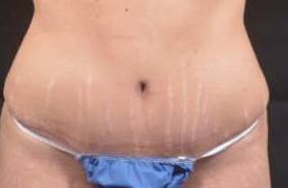 Abdominoplasty Before & After Gallery - Patient 117112 - Image 2