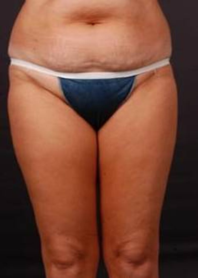 Abdominoplasty Before & After Gallery - Patient 199110 - Image 1