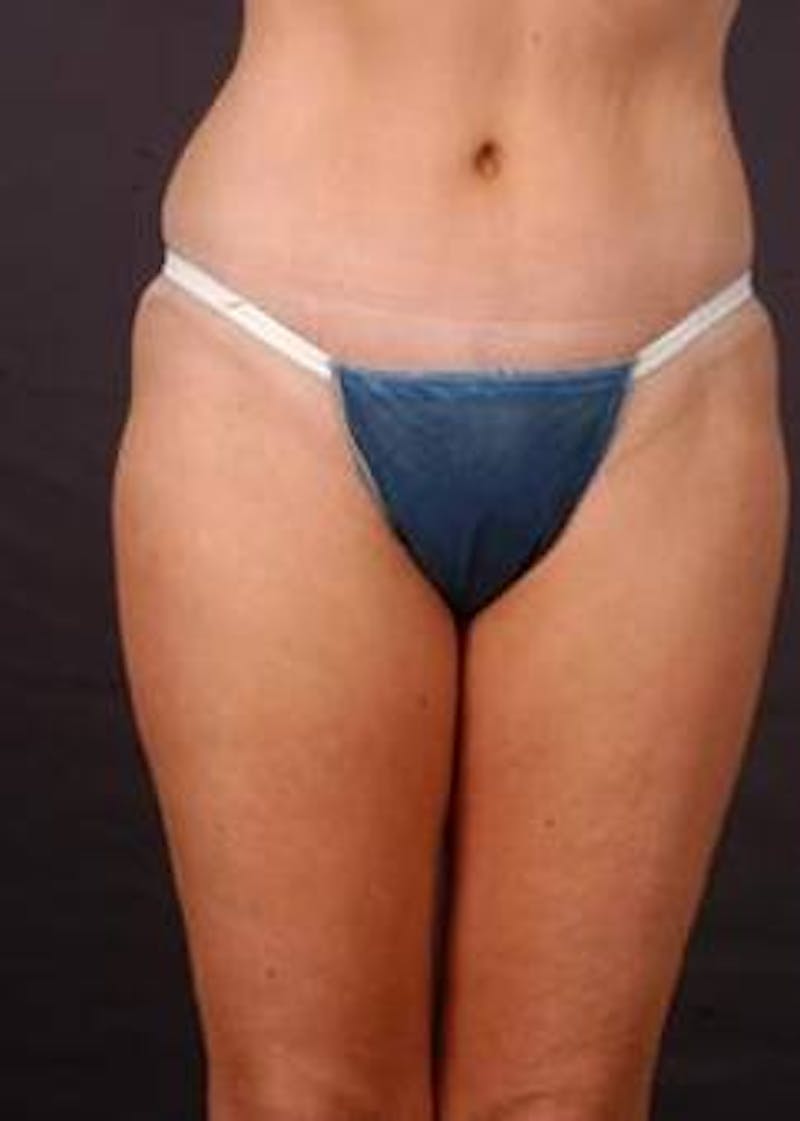 Abdominoplasty Before & After Gallery - Patient 199110 - Image 2