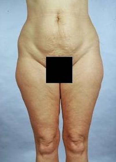 360 Liposuction Before & After Gallery - Patient 345880 - Image 1