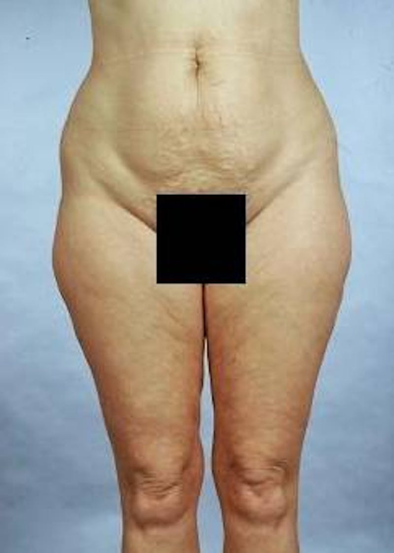 360 Liposuction Before & After Gallery - Patient 345880 - Image 1
