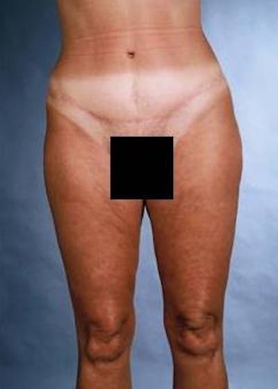 360 Liposuction Before & After Gallery - Patient 345880 - Image 2