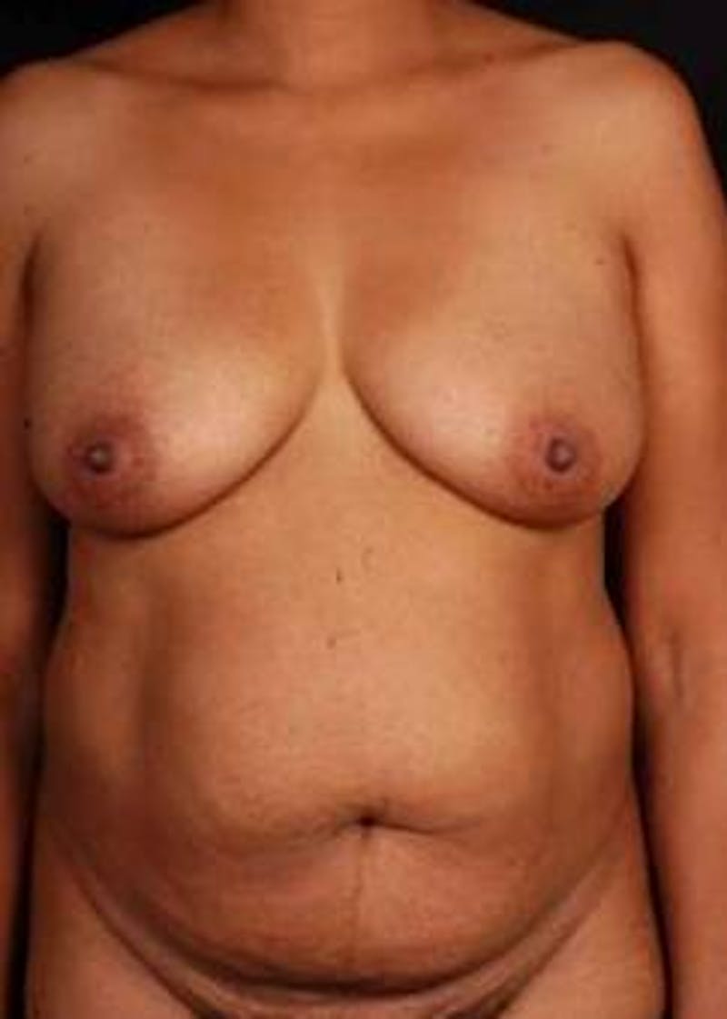 Abdominoplasty Before & After Gallery - Patient 965630 - Image 1