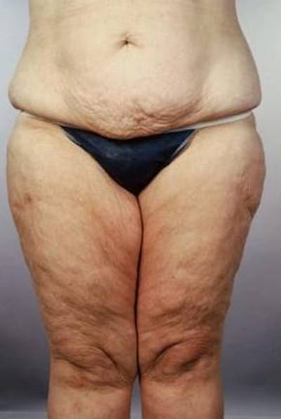 Abdominoplasty Before & After Gallery - Patient 124788 - Image 1