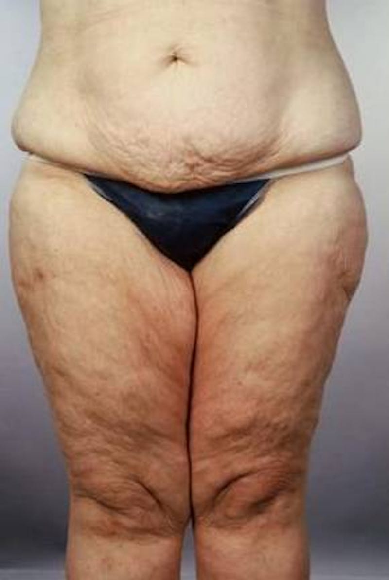 Abdominoplasty Before & After Gallery - Patient 124788 - Image 1