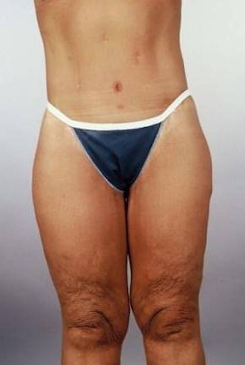 Abdominoplasty Before & After Gallery - Patient 124788 - Image 2