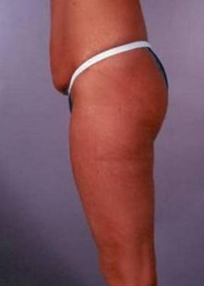 Abdominoplasty Before & After Gallery - Patient 380290 - Image 1
