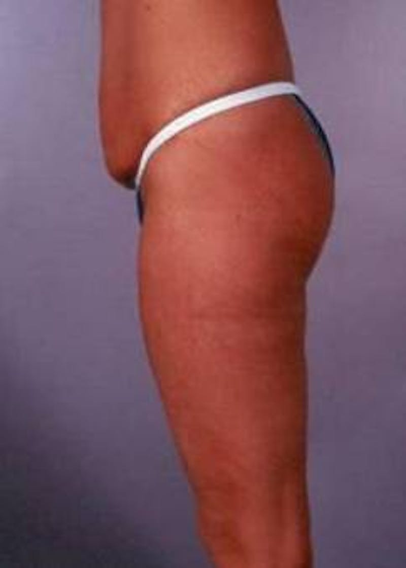 Abdominoplasty Before & After Gallery - Patient 380290 - Image 1