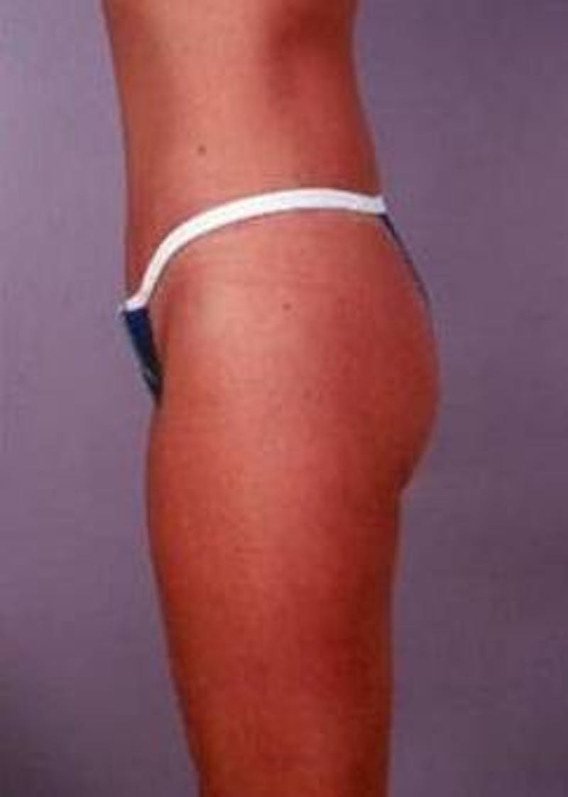 Abdominoplasty Before & After Gallery - Patient 380290 - Image 2
