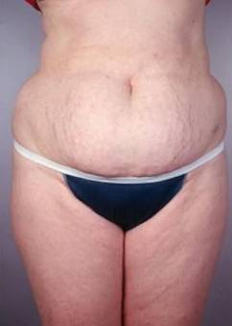 Abdominoplasty Before & After Gallery - Patient 196193 - Image 1