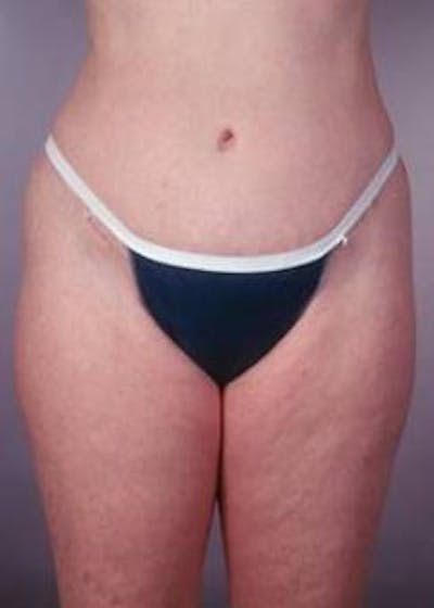 Abdominoplasty Before & After Gallery - Patient 196193 - Image 2