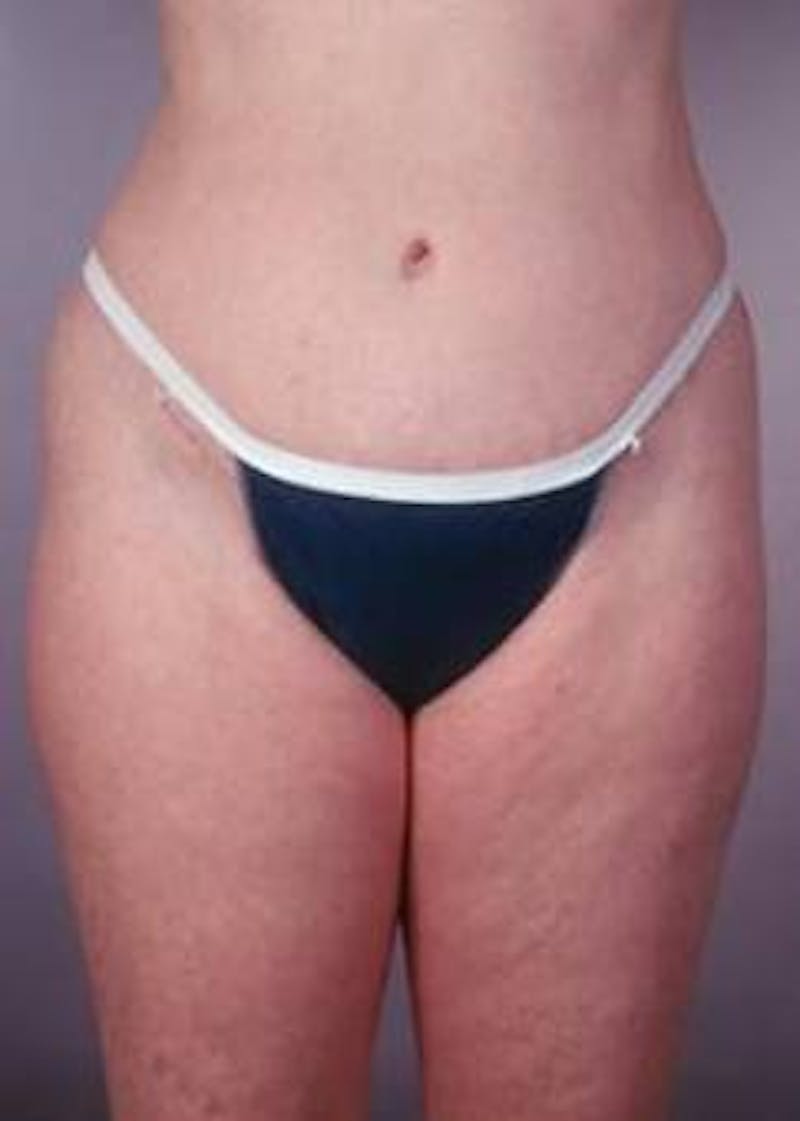 Abdominoplasty Before & After Gallery - Patient 196193 - Image 2