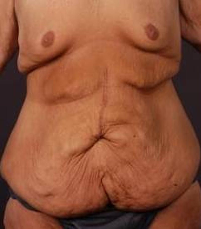 Abdominoplasty Before & After Gallery - Patient 286840 - Image 1