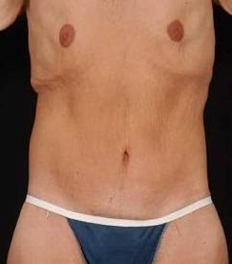 Abdominoplasty Before & After Gallery - Patient 286840 - Image 2