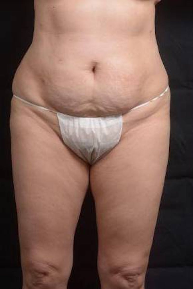 Abdominoplasty Before & After Gallery - Patient 129456 - Image 1