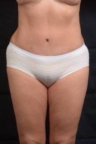 Abdominoplasty Before & After Gallery - Patient 129456 - Image 2