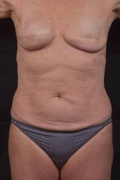Abdominoplasty Before & After Gallery - Patient 275315 - Image 1