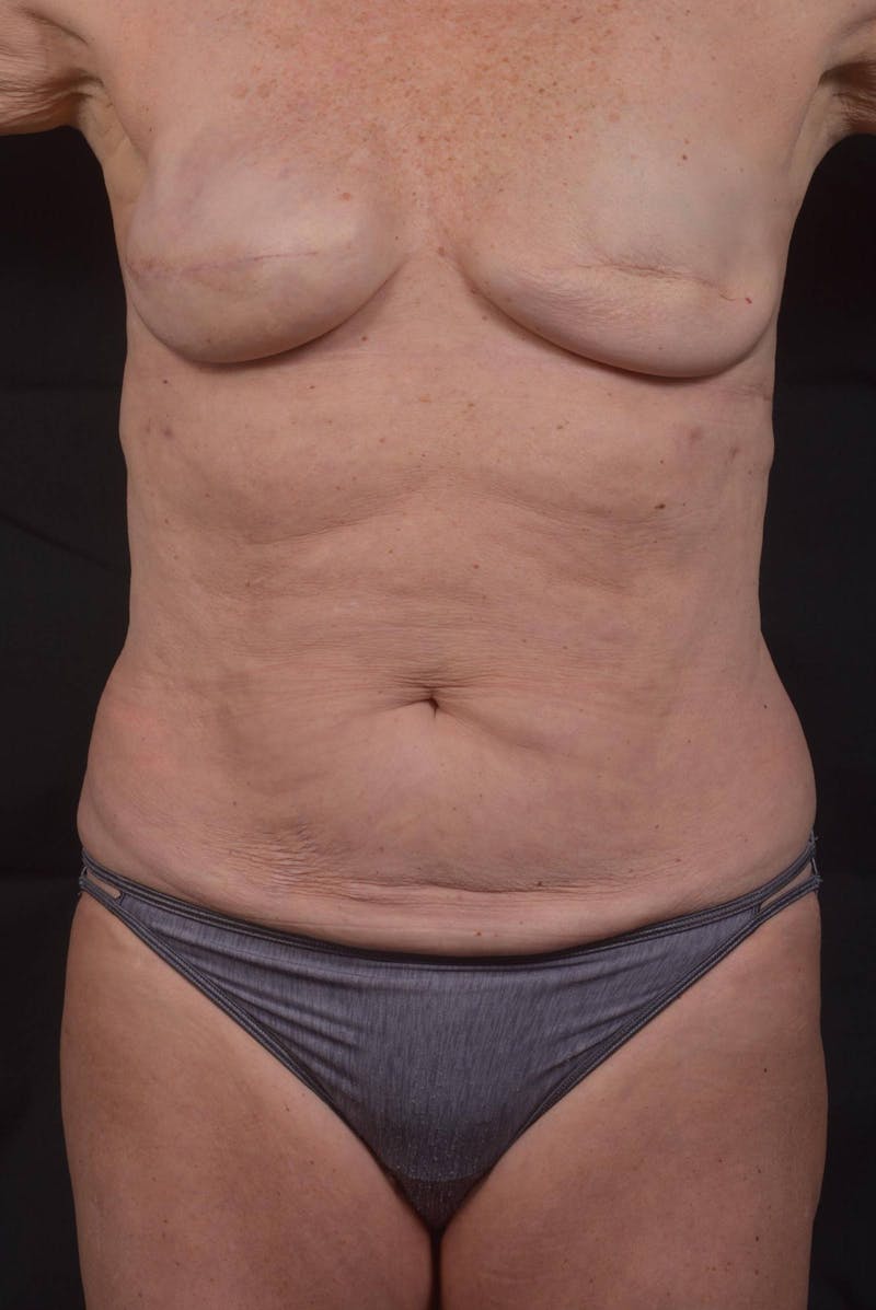 Abdominoplasty Before & After Gallery - Patient 275315 - Image 1