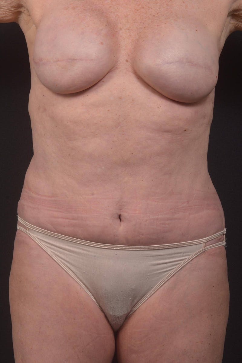 Abdominoplasty Before & After Gallery - Patient 275315 - Image 2