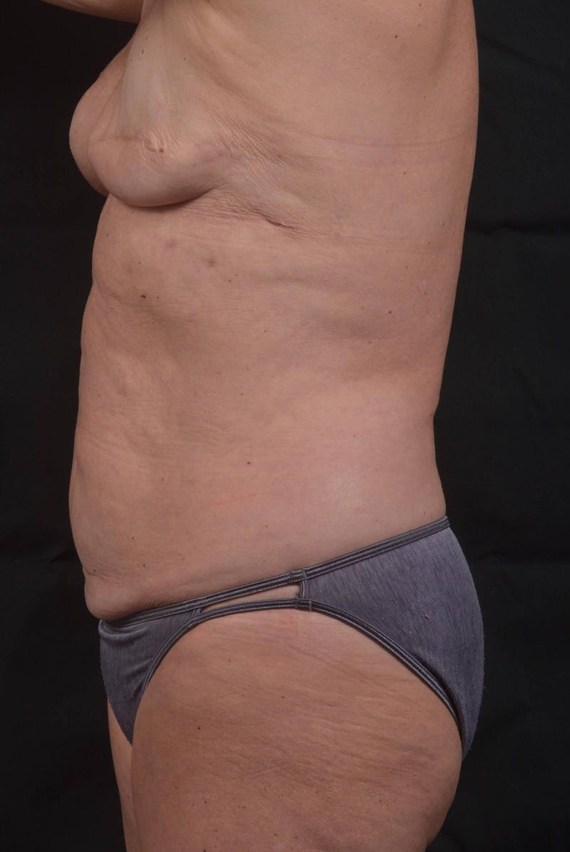 Abdominoplasty Before & After Gallery - Patient 275315 - Image 3