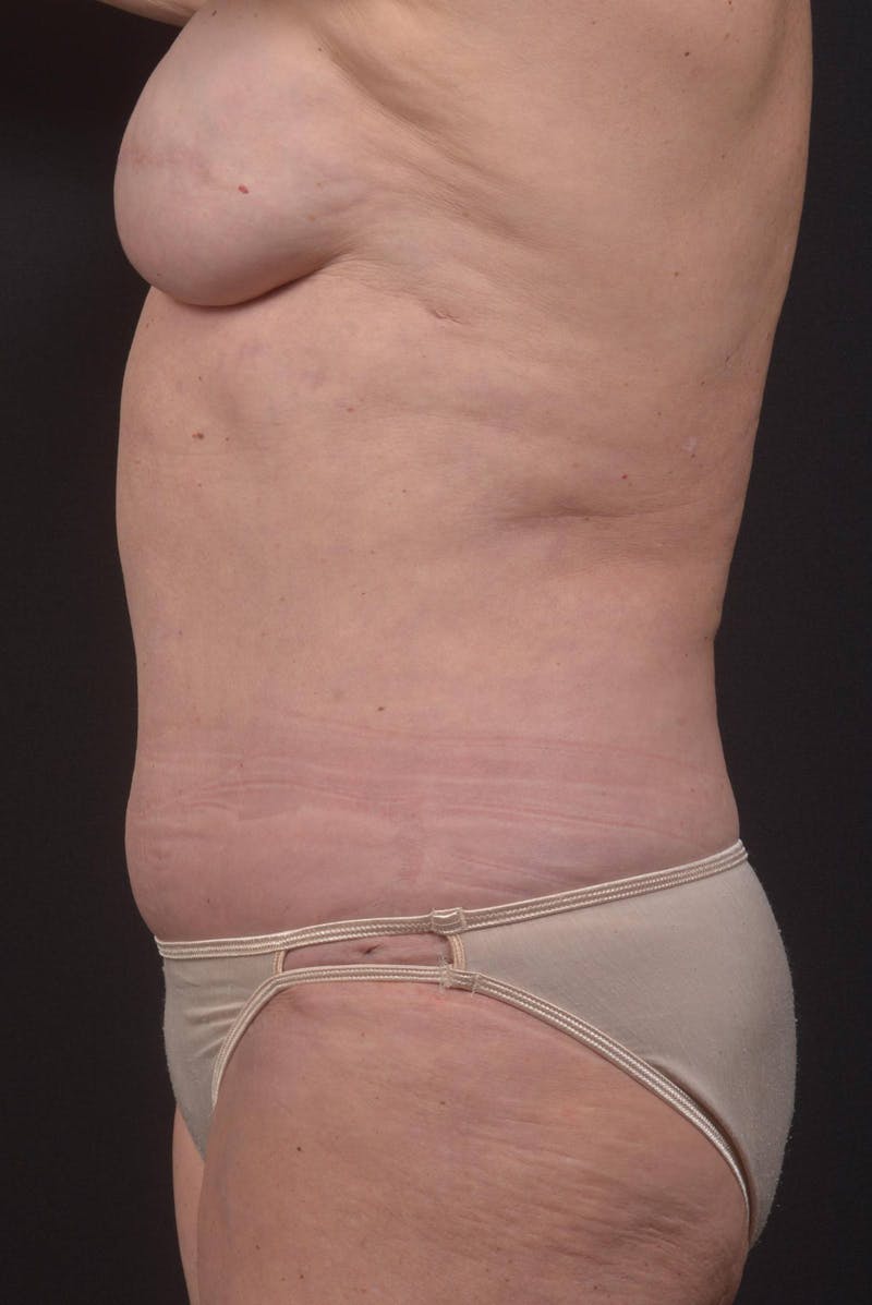 Abdominoplasty Before & After Gallery - Patient 275315 - Image 4