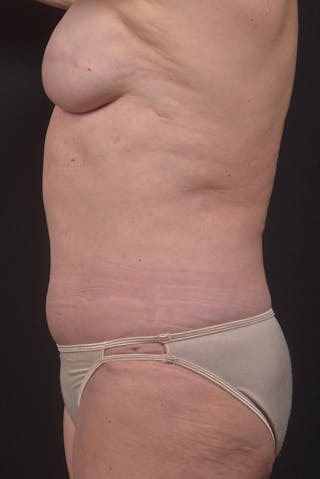 Abdominoplasty Before & After Gallery - Patient 275315 - Image 4