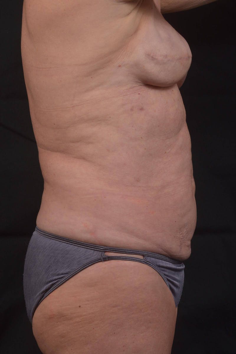 Abdominoplasty Before & After Gallery - Patient 275315 - Image 5
