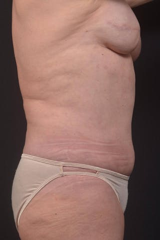 Abdominoplasty Before & After Gallery - Patient 275315 - Image 6