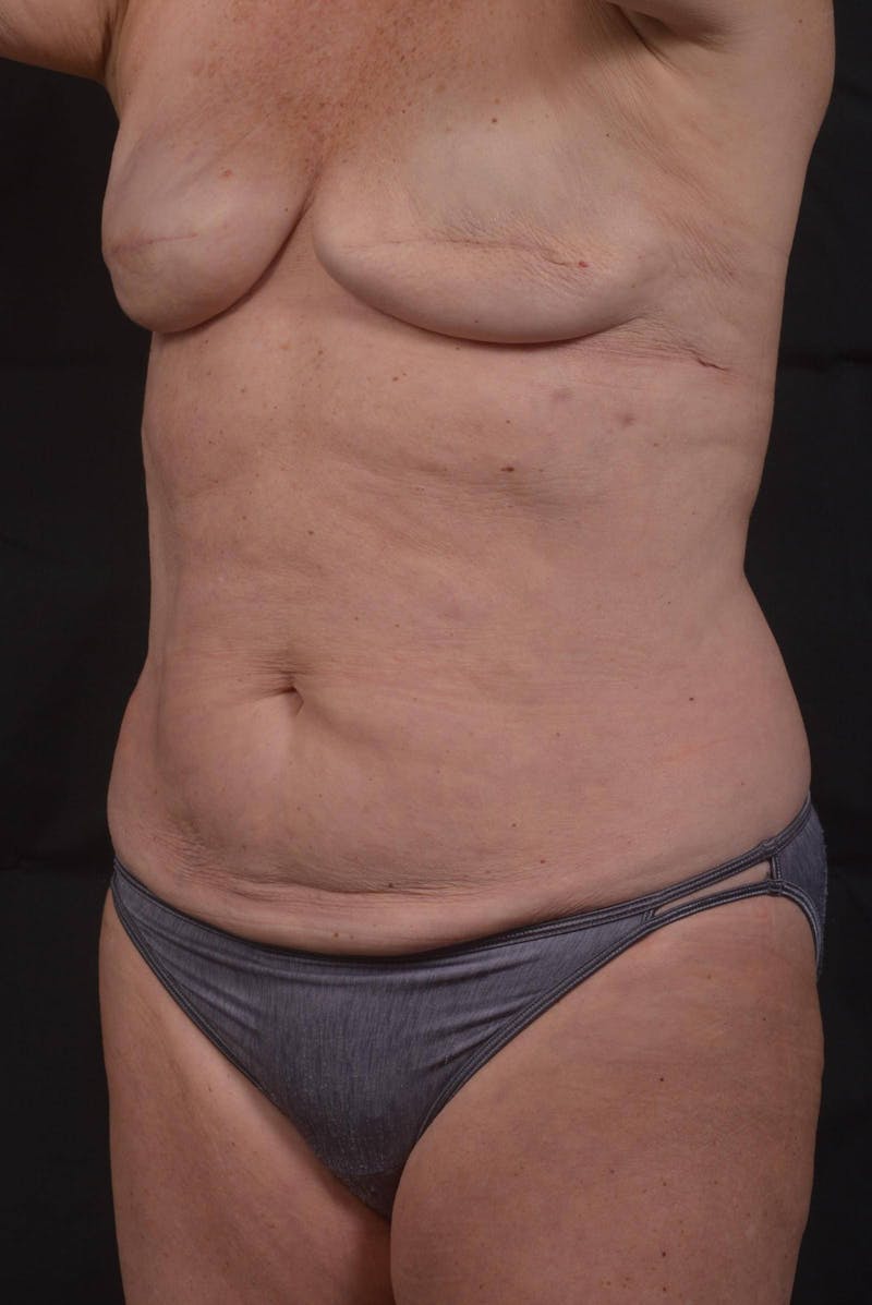 Abdominoplasty Before & After Gallery - Patient 275315 - Image 7