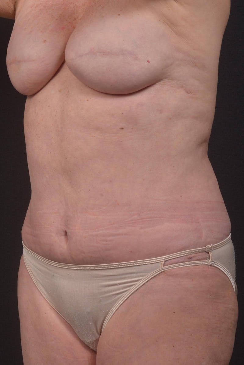 Abdominoplasty Before & After Gallery - Patient 275315 - Image 8