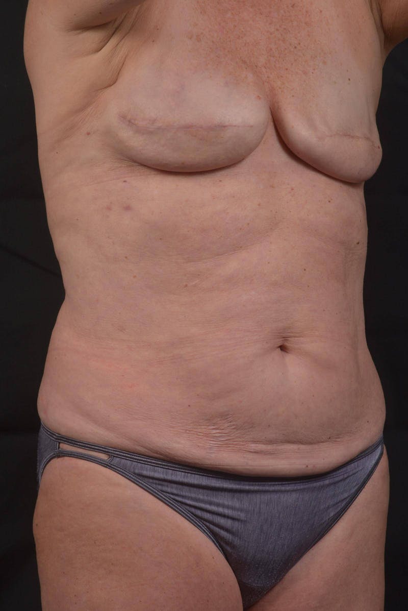 Abdominoplasty Before & After Gallery - Patient 275315 - Image 9
