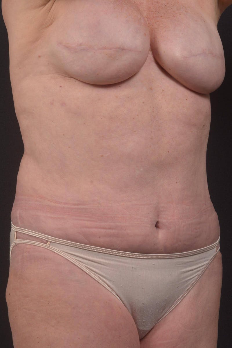 Abdominoplasty Before & After Gallery - Patient 275315 - Image 10