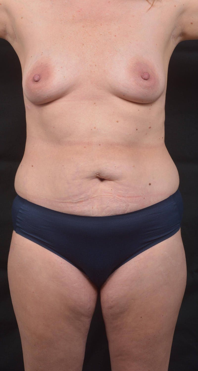 Abdominoplasty Before & After Gallery - Patient 285380 - Image 1
