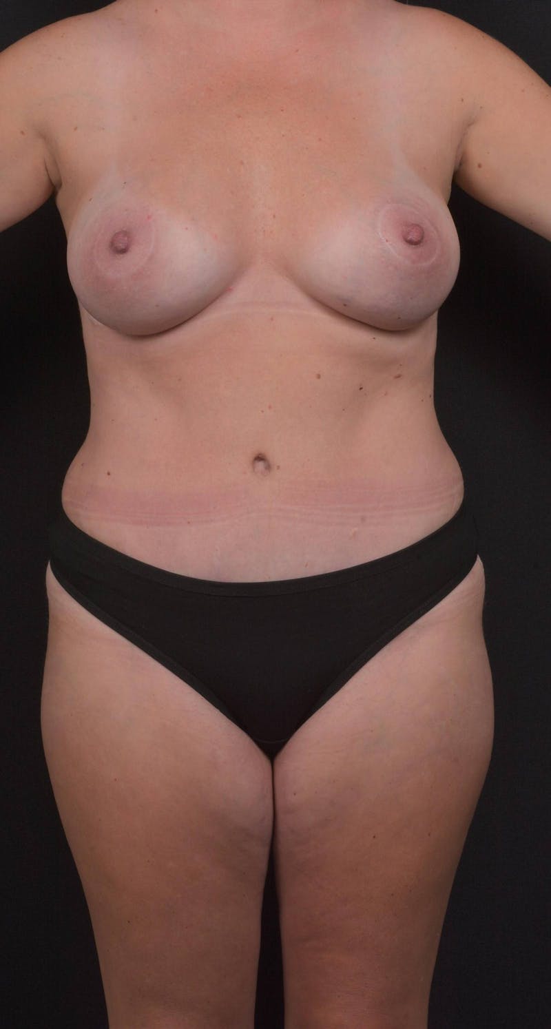 Abdominoplasty Before & After Gallery - Patient 285380 - Image 2