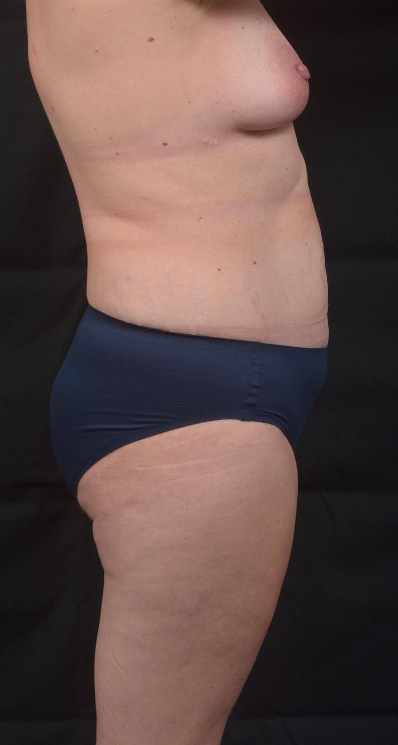 Abdominoplasty Before & After Gallery - Patient 285380 - Image 5
