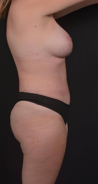 Abdominoplasty Before & After Gallery - Patient 285380 - Image 6