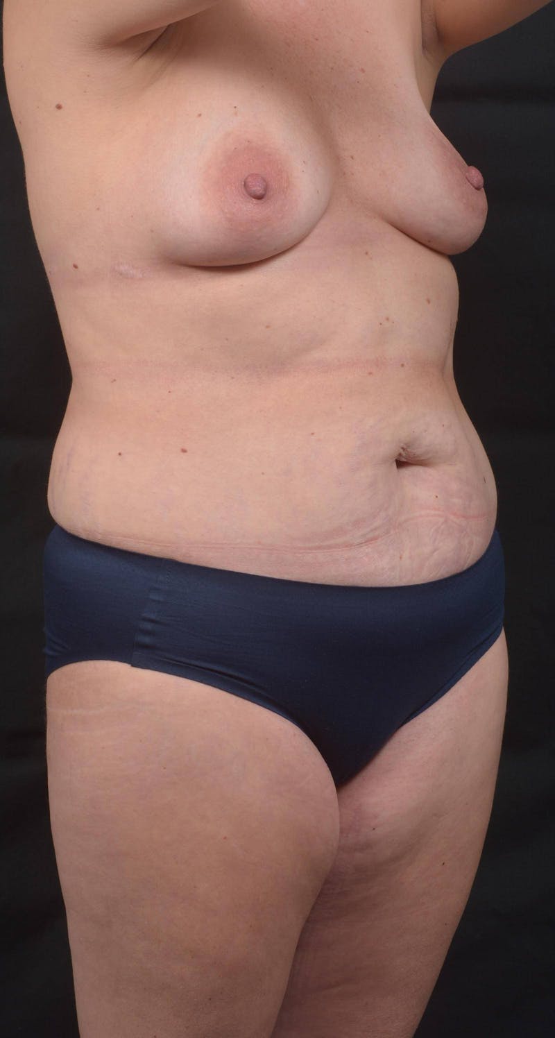 Abdominoplasty Before & After Gallery - Patient 285380 - Image 9