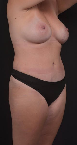 Abdominoplasty Before & After Gallery - Patient 285380 - Image 10