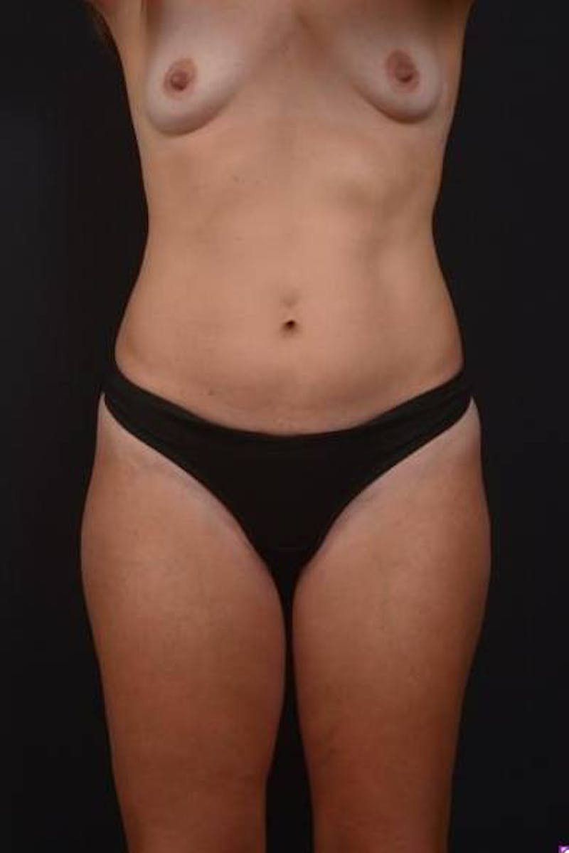Abdominoplasty Before & After Gallery - Patient 115195 - Image 1