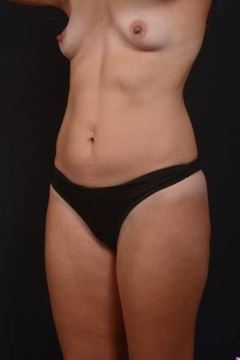 Abdominoplasty Before & After Gallery - Patient 115195 - Image 3