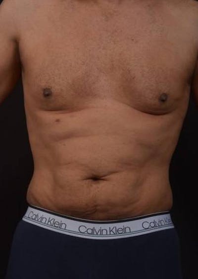 Abdominoplasty Before & After Gallery - Patient 153683 - Image 1