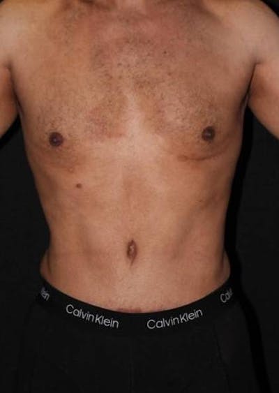 Abdominoplasty Before & After Gallery - Patient 153683 - Image 2