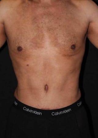 360 Liposuction Before & After Gallery - Patient 190711 - Image 2