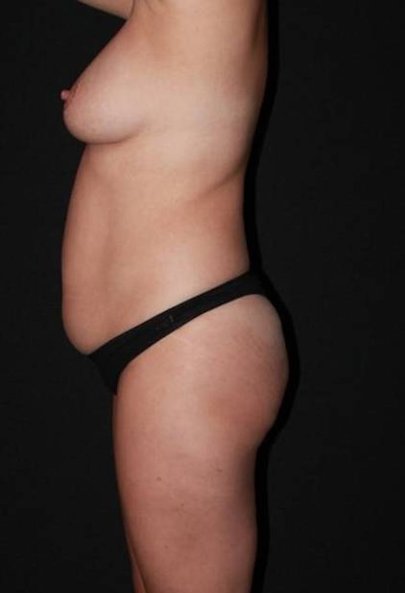 Abdominoplasty Before & After Gallery - Patient 272516 - Image 5