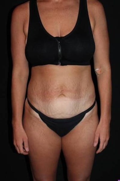 Abdominoplasty Before & After Gallery - Patient 856729 - Image 1
