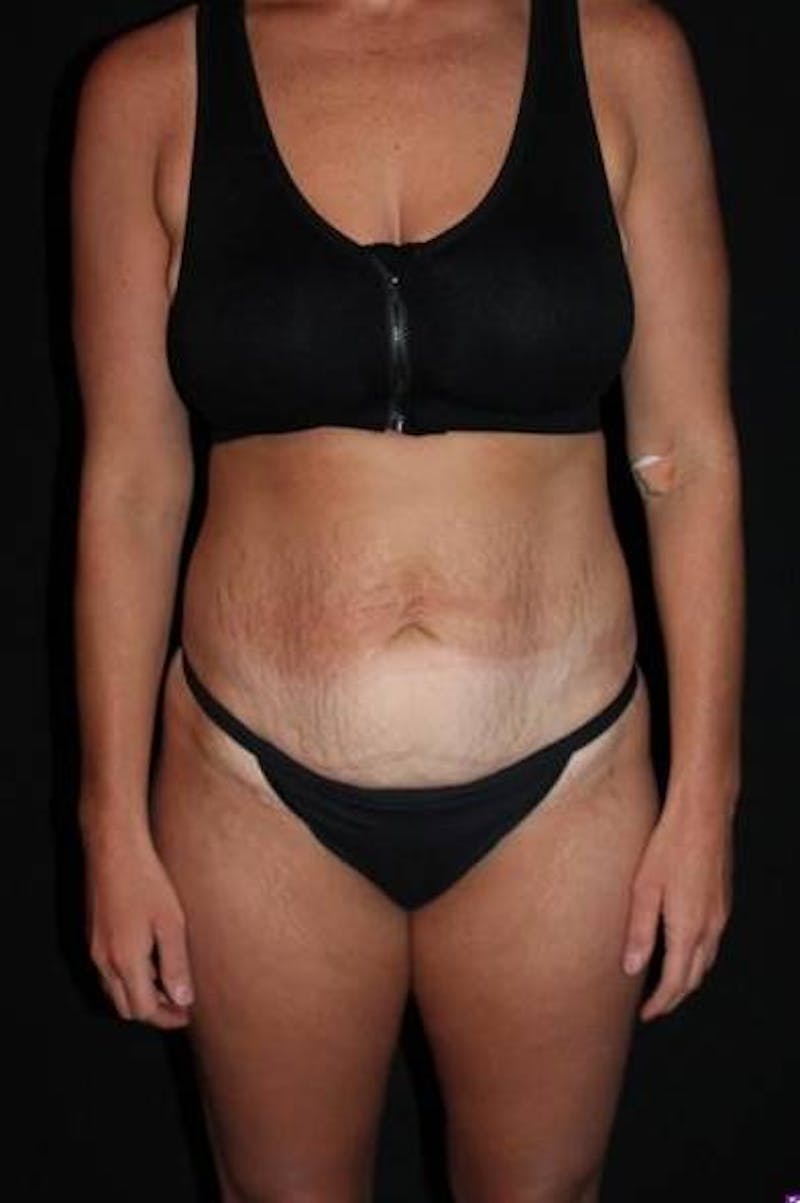 Abdominoplasty Before & After Gallery - Patient 856729 - Image 1
