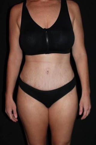 Abdominoplasty Before & After Gallery - Patient 856729 - Image 2