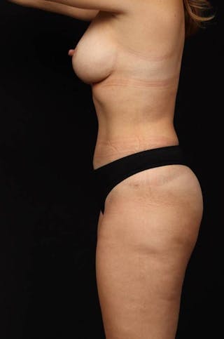 Abdominoplasty Before & After Gallery - Patient 305998 - Image 6